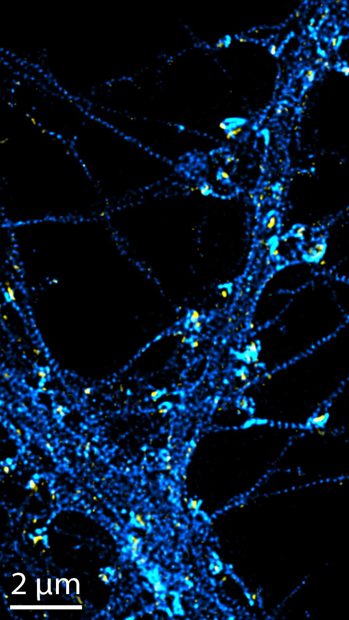 microscopic picture of three hippocampal pyramidal neurons